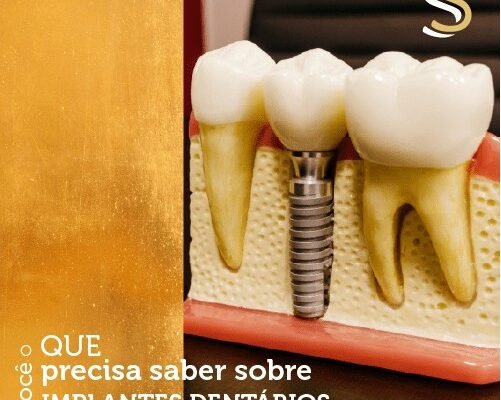 O que você precisa saber sobre implantes dentários